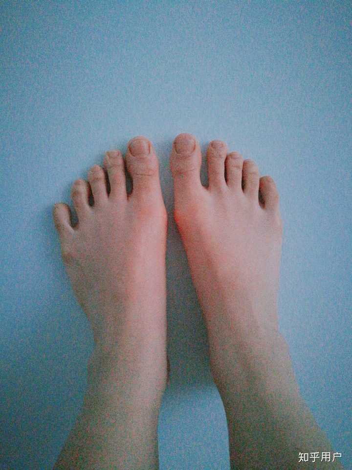 脚宽可以后天改变么?