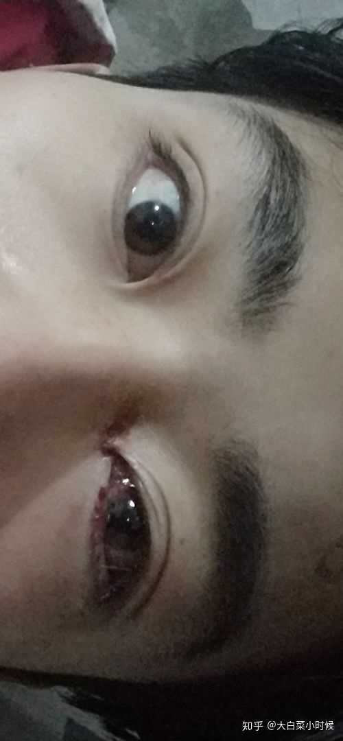 斜视手术是一种怎样的体验?