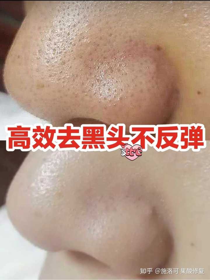 想要去黑头收藏这一篇就够了(密集恐惧者慎入)