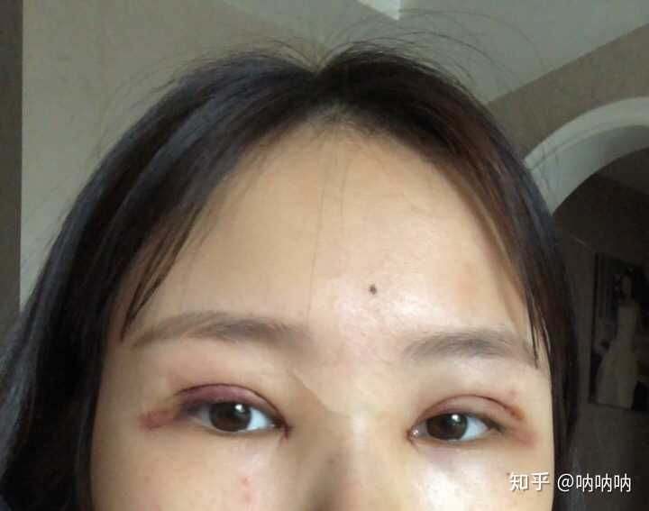 割双眼皮是种怎样的体验?