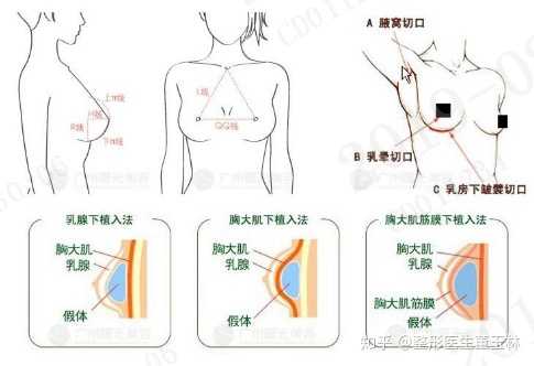 假体隆胸效果怎么样?