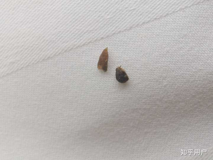 史上最大的黑头有多大?