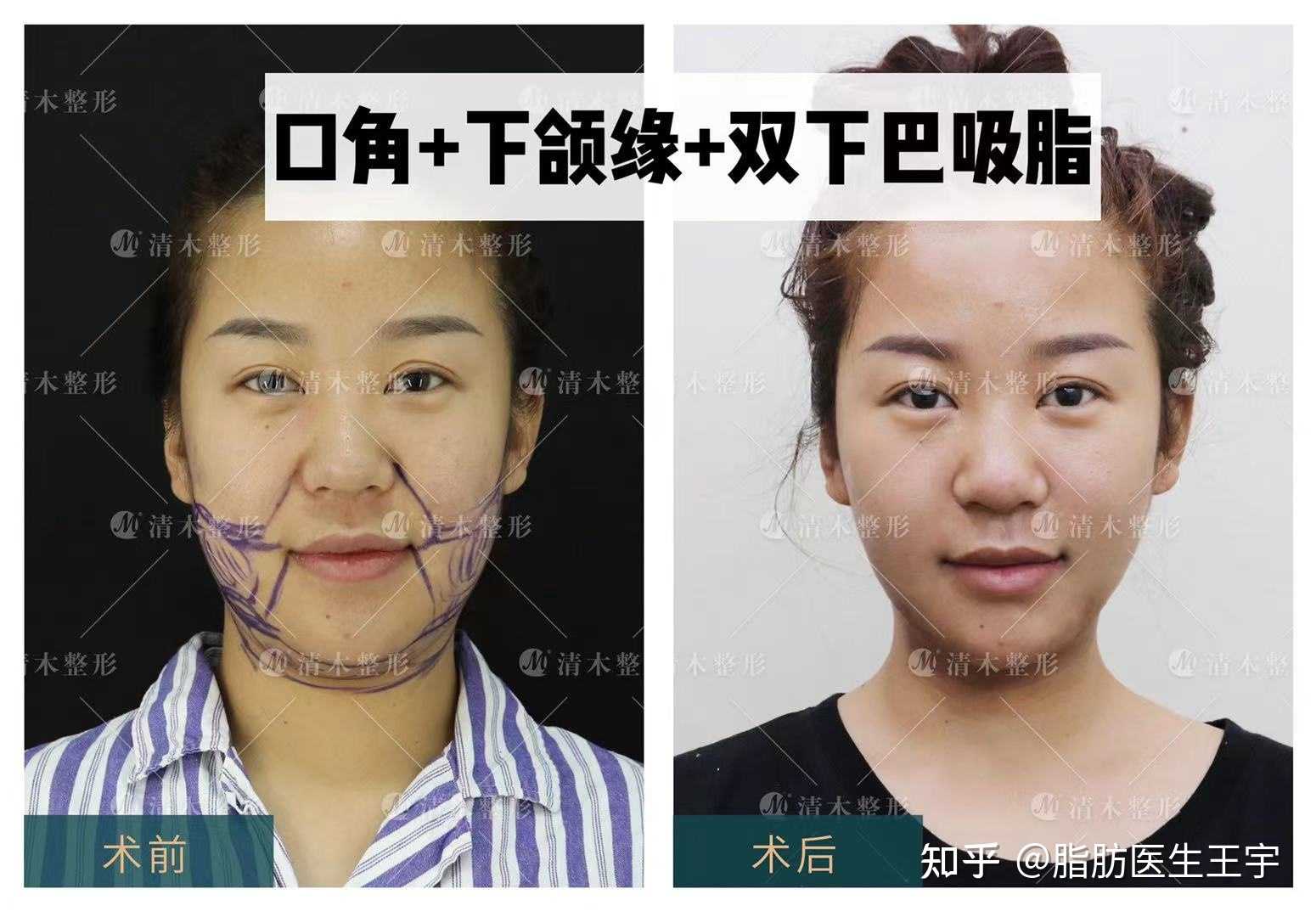 口角下颌缘双下巴吸脂