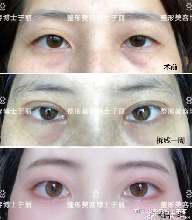 想做双眼皮全切手术,我这样的条件效果好不好,需不需要提肌提眉开眼角