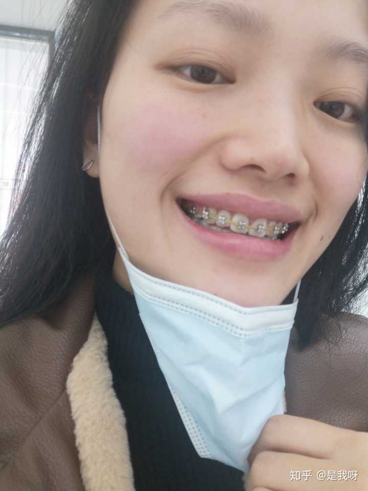 摘下牙套的你们都怎么样了?