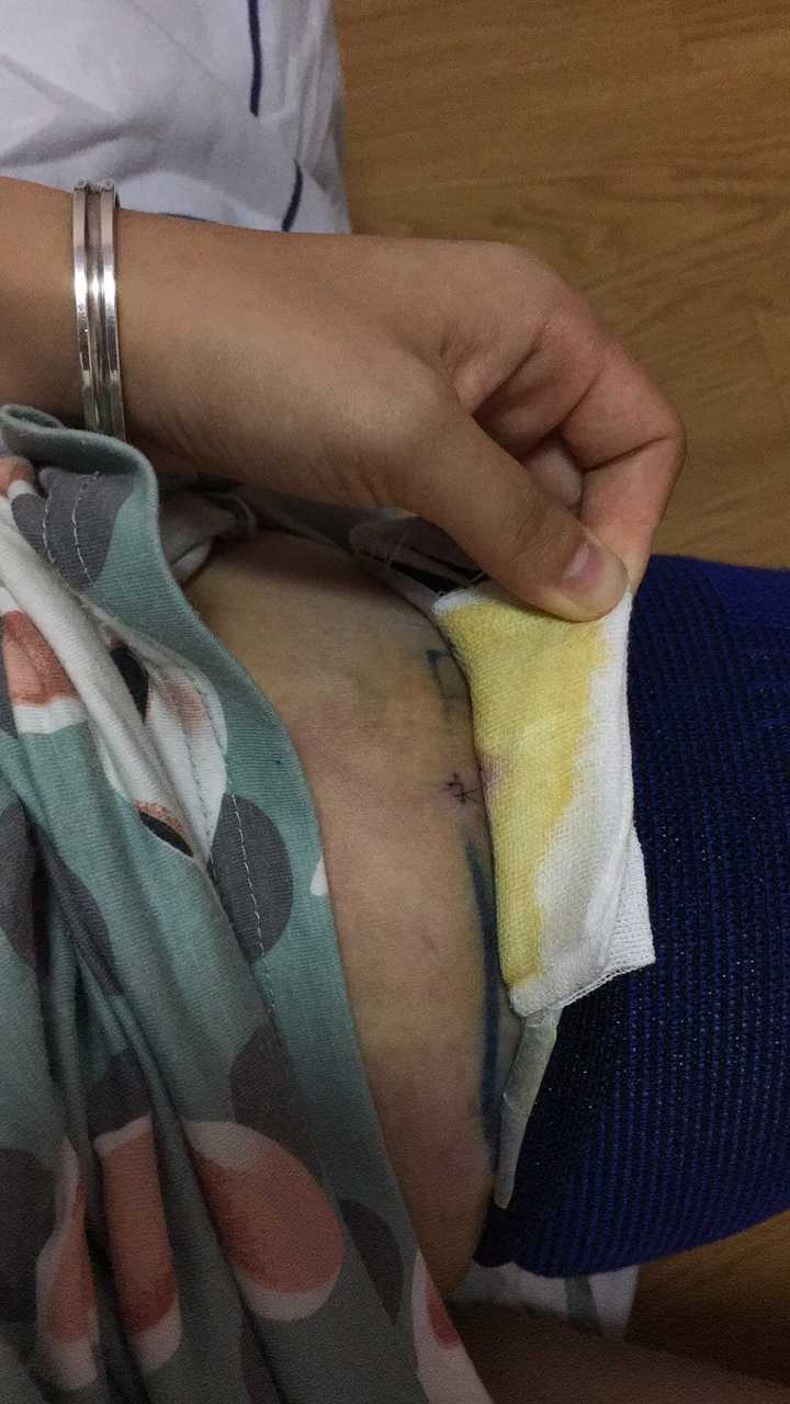 大腿抽脂是什么样的体验?