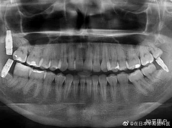 拔掉智齿再种植(说真的,这个种植难度不小,病人的张口度受到了极大的