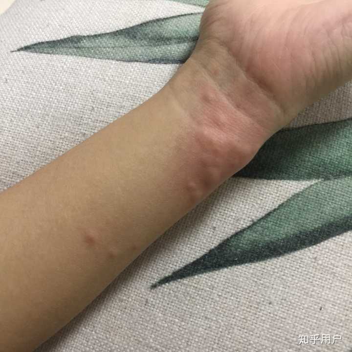 被水母蛰是一种什么体验?