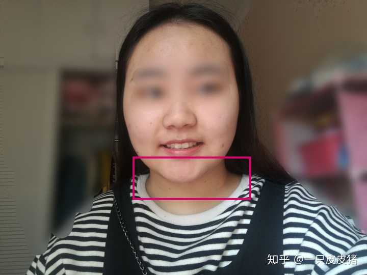 没戴牙套之前:下牙被覆盖完,甚至咬到了上牙鄂那里…两颗门牙突出,内
