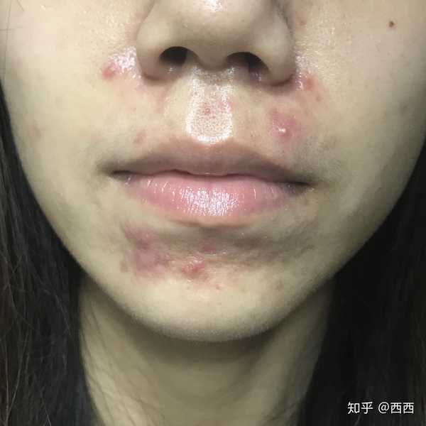 如何治疗痤疮?