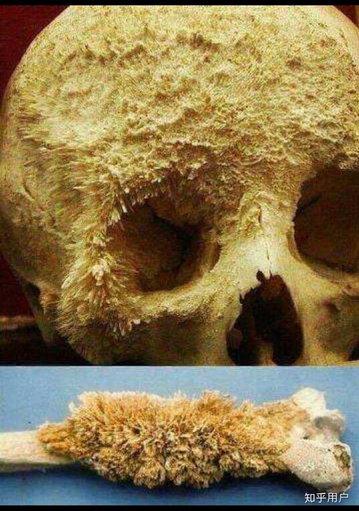 这个是骨癌患者的骨头,你觉得把骨头长到这样效果的过程是慷慨吗?