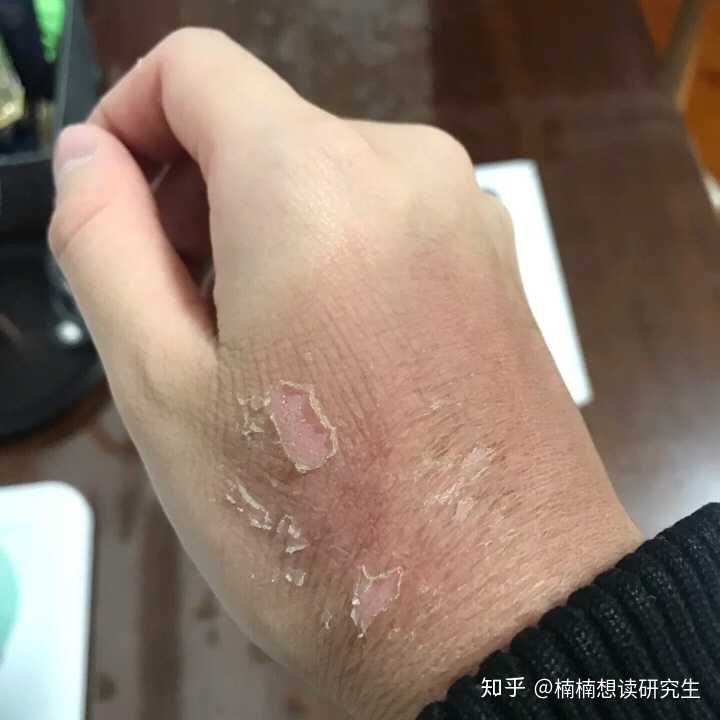 手烫伤了怎么办,起泡了?