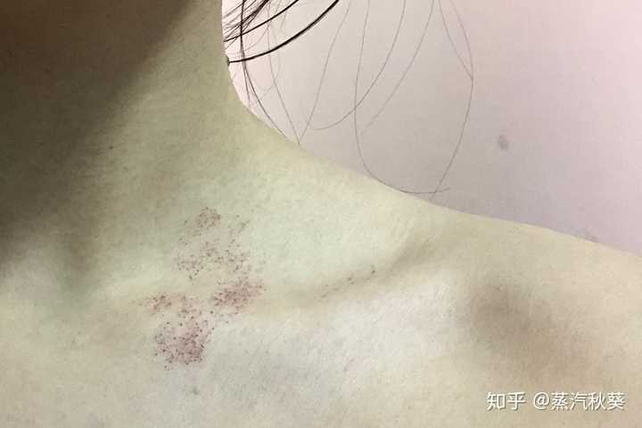 脖子处有类似吻痕的红印,但我肯定不是吻痕,几年了都没消,有懂的人