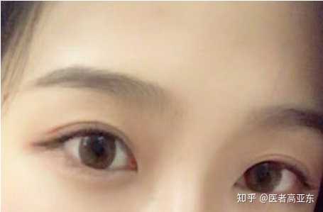 内双的人割双眼皮会更自然吗?