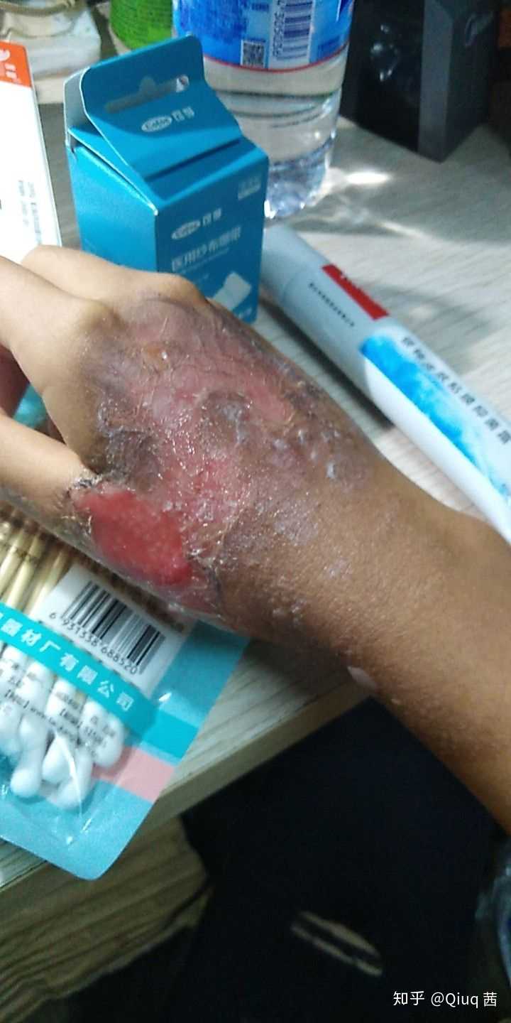 40摔了一下暖壶碎了,右手烫伤,海口的水龙头里出来的水本来就是热的.