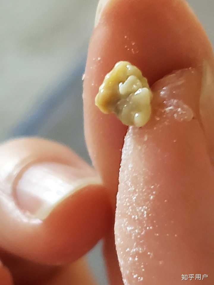 你见过最大的扁桃体结石有多大