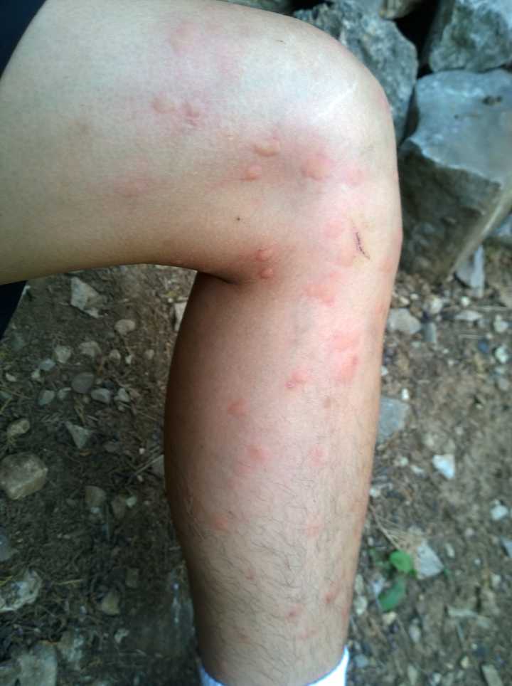 让源源不断的蚊子咬一个人,他会失血过多而死吗?