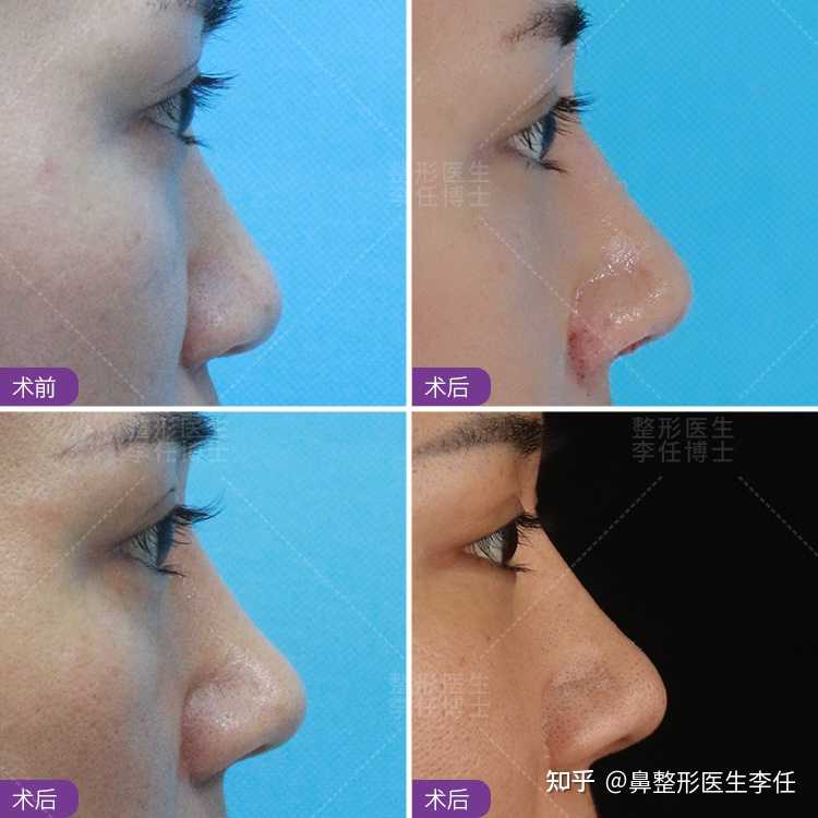鼻翼肥大或宽大是亚洲人或者说中国人比较常见的现象一般可以随鼻部