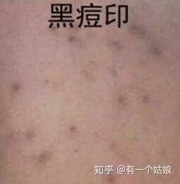 红色痘印受到紫外线的照射或炎症的侵扰,皮肤为了保护自己 黑色素细胞