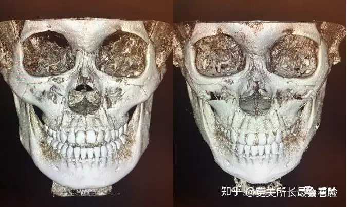 手术之后的骨骼对比图如下,可以看到颧骨颧弓明显内收
