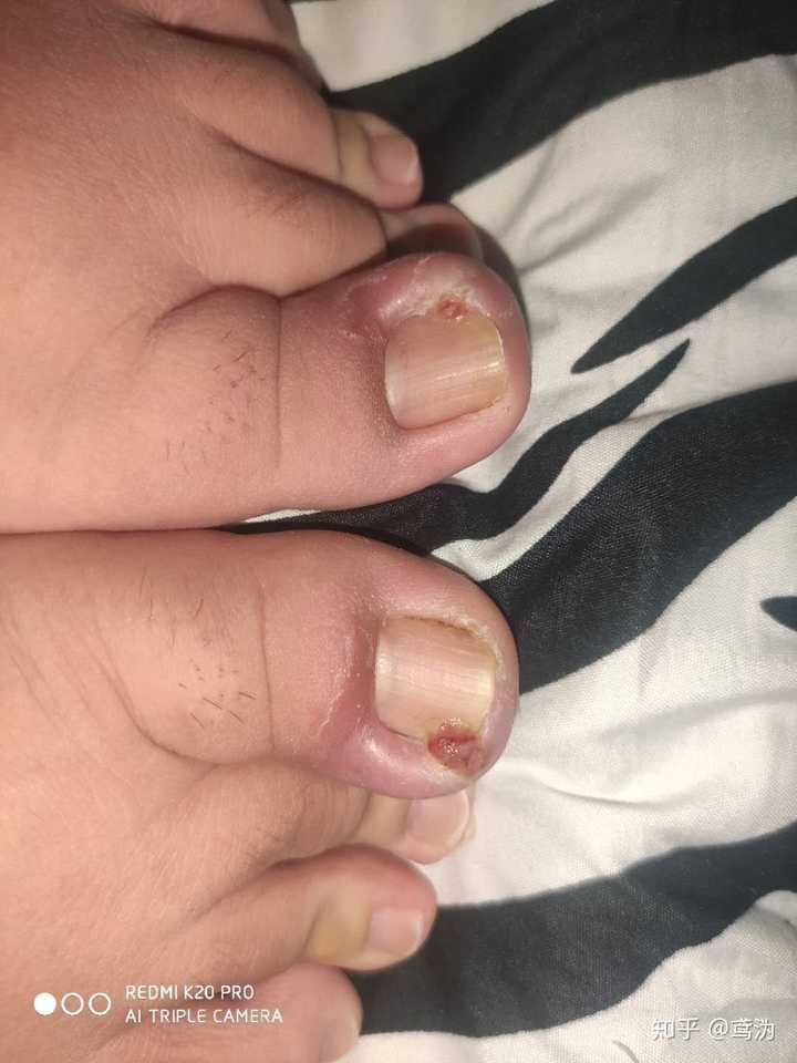 你们的甲沟炎最后都是怎么治好的 ?