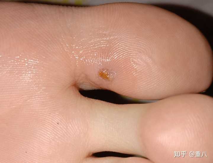 我之前不选择激光很大的原因就是我以为激光是不打麻药的.