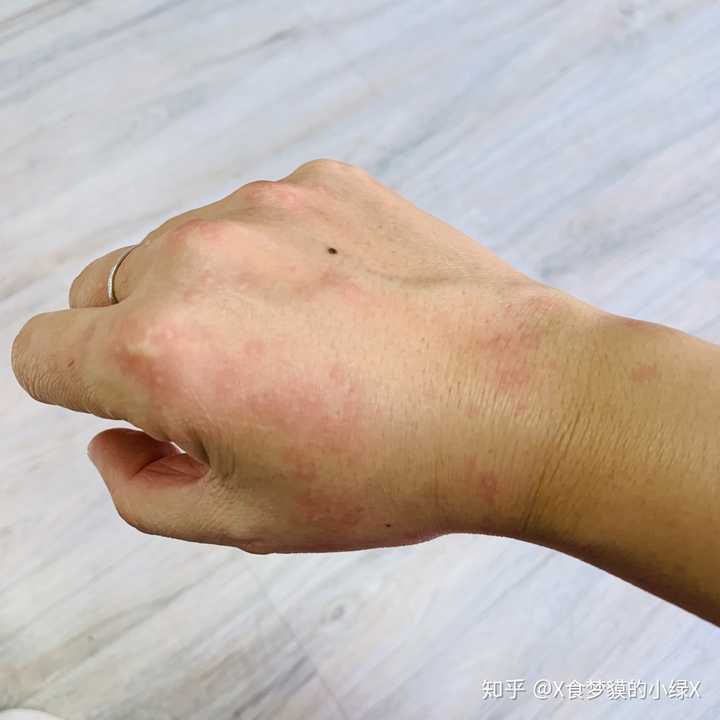被水母蛰是一种什么体验?