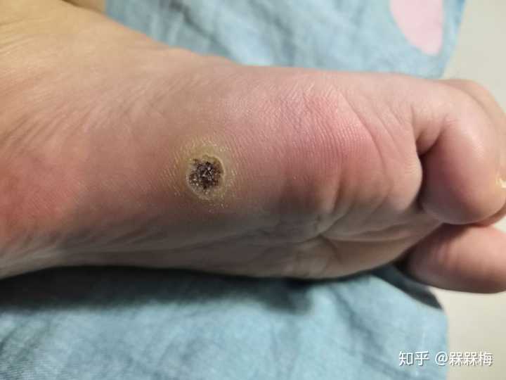 得了趾疣是一种什么样的体验?怎么样才能治好?