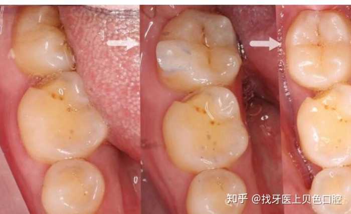 一侧下牙床最里面的磨牙长歪要怎么办?