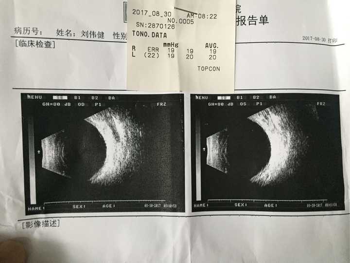 眼科b超怎么看?