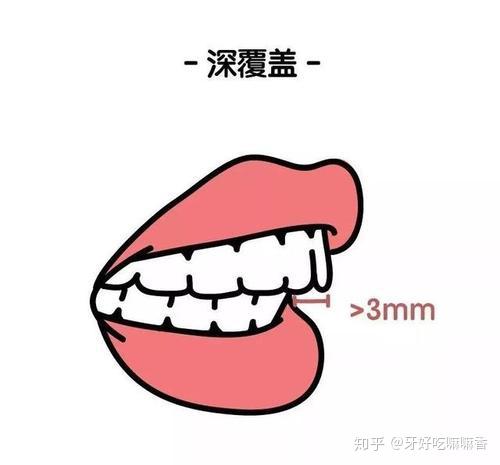 双颌前突或者上下前牙向前突出.嘴唇用力才能闭上,经常开唇露齿.