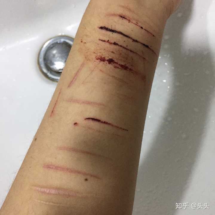 情绪一激动就想自残怎么办?