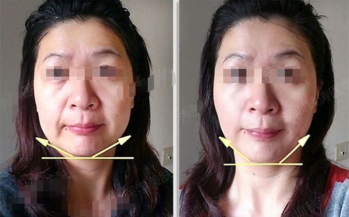 我人很瘦,但是脸很胖还有双下巴,怎么减掉双下巴呢?