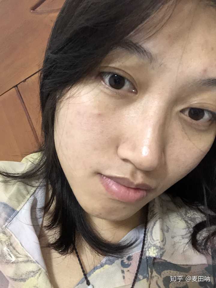 怎么看待五官漂亮但是皮肤差的女性?