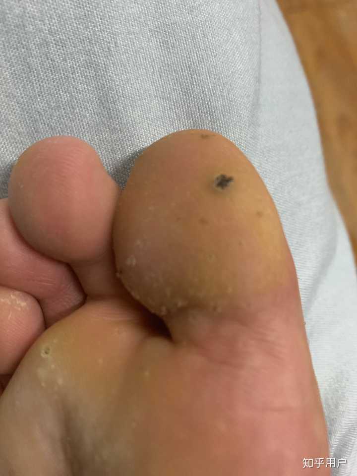 跖疣的自愈性大吗?