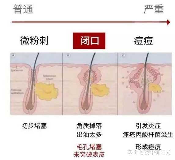 闭口粉刺怎么去除?