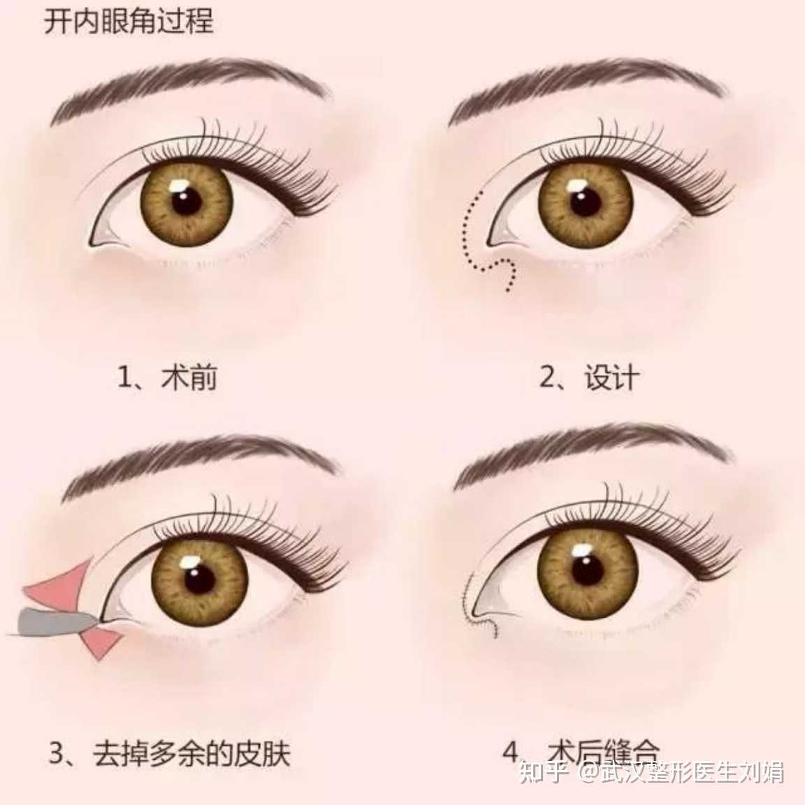 开眼角的两种情况