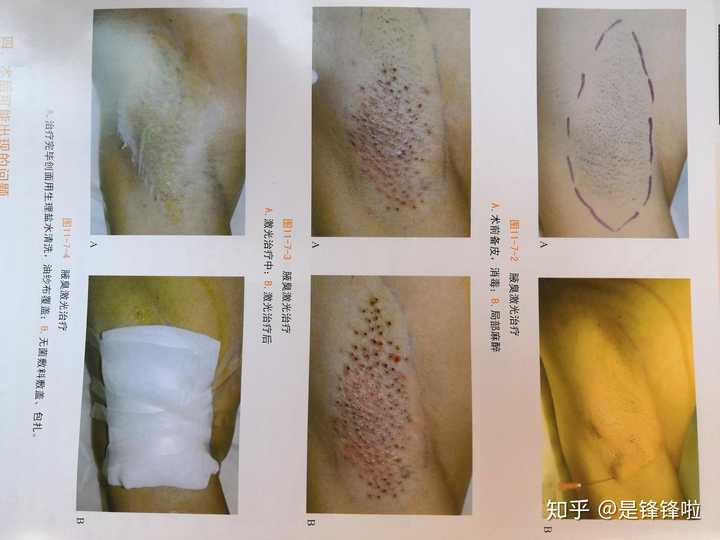 原理就是破坏汗腺开口,使汗腺萎缩闭塞从而治疗狐臭