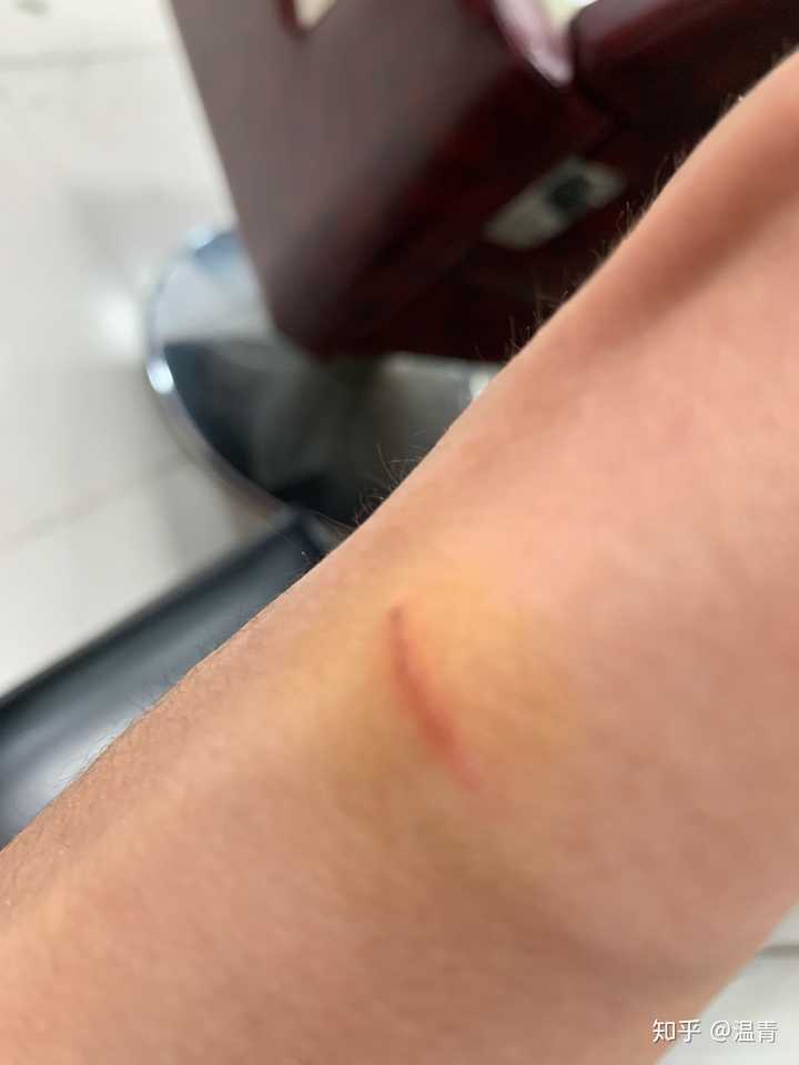被猫抓出血这种程度需要去打疫苗吗?