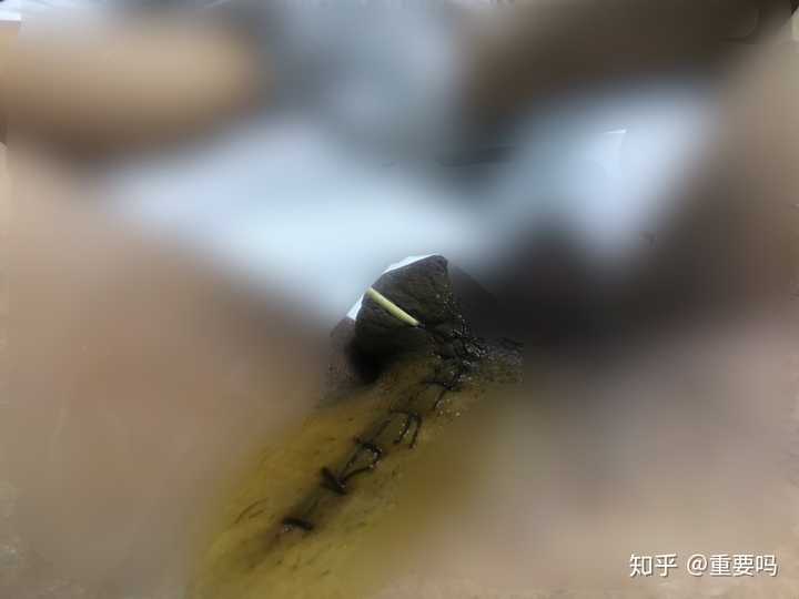 睾丸扭转是什么样的体验?