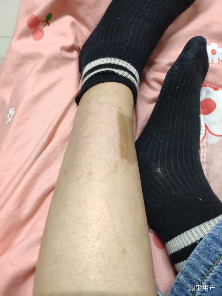 腿上有胎记夏天不能穿裙子怎么办?