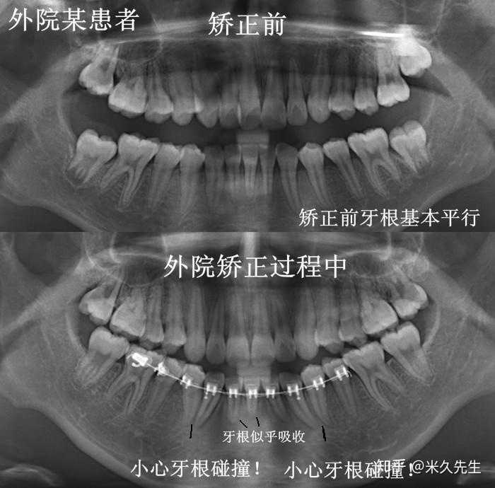 牙根吸收