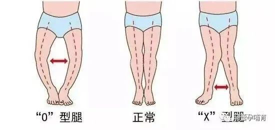 x型腿(内外八字) 其实,宝宝刚出生的时候基本都会有点o型腿,18个月