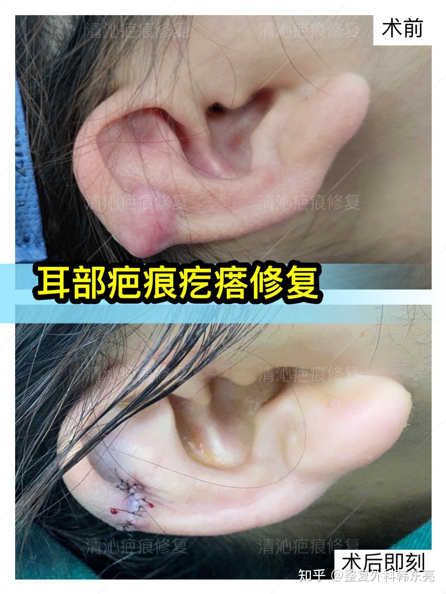 疤痕疙瘩修复临床上顾客最为关心的问题之一就是经过手术后我的耳朵