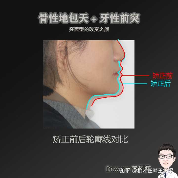 以下是我经手过顾客矫正前后对比图的案例,主诉是骨性地包天牙性前突