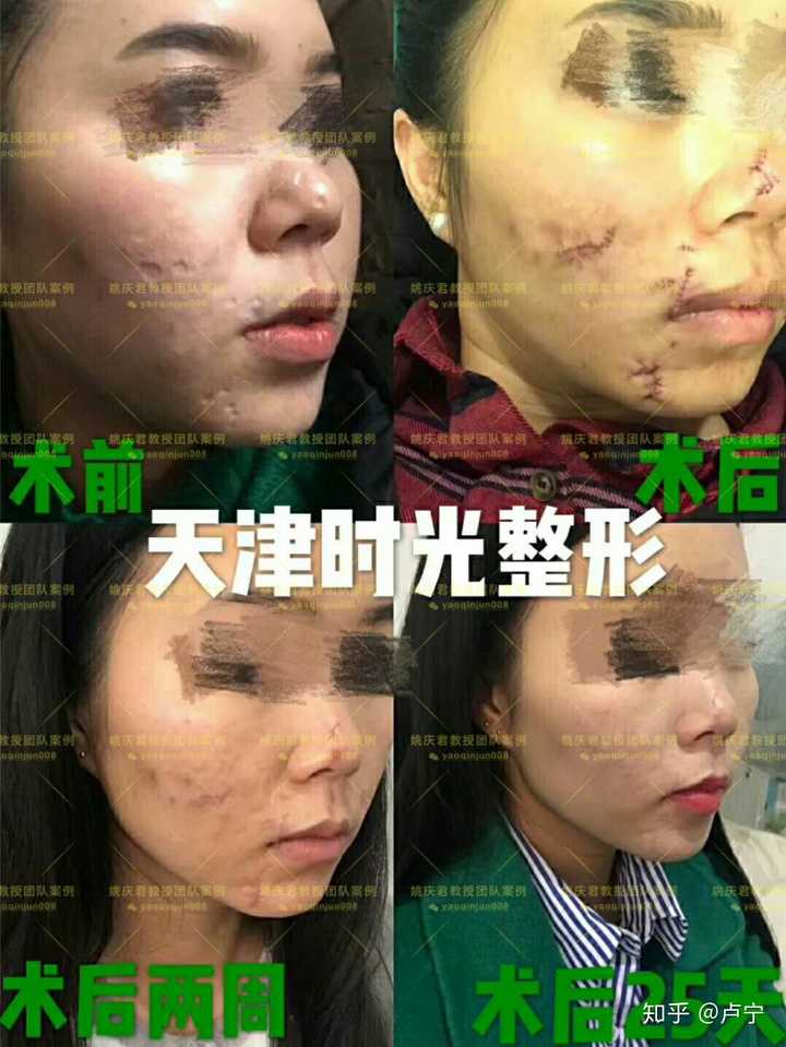 水痘疤痕怎么去除?