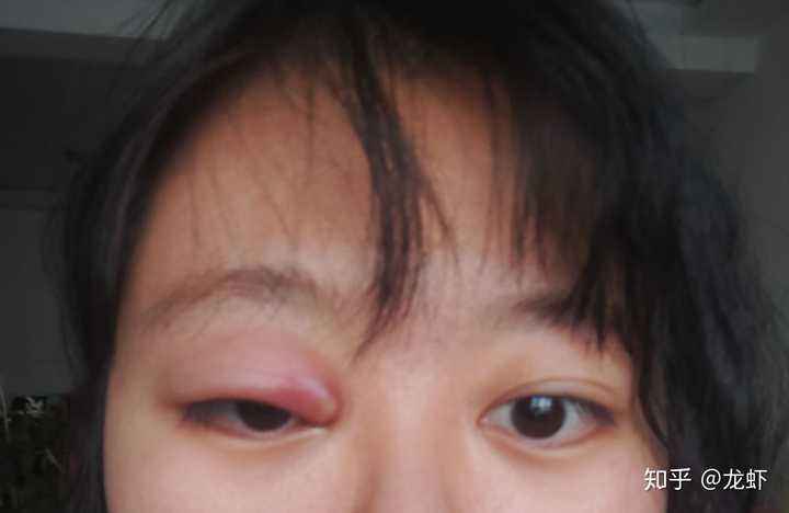 眼睛麦粒肿初期症状有哪些?