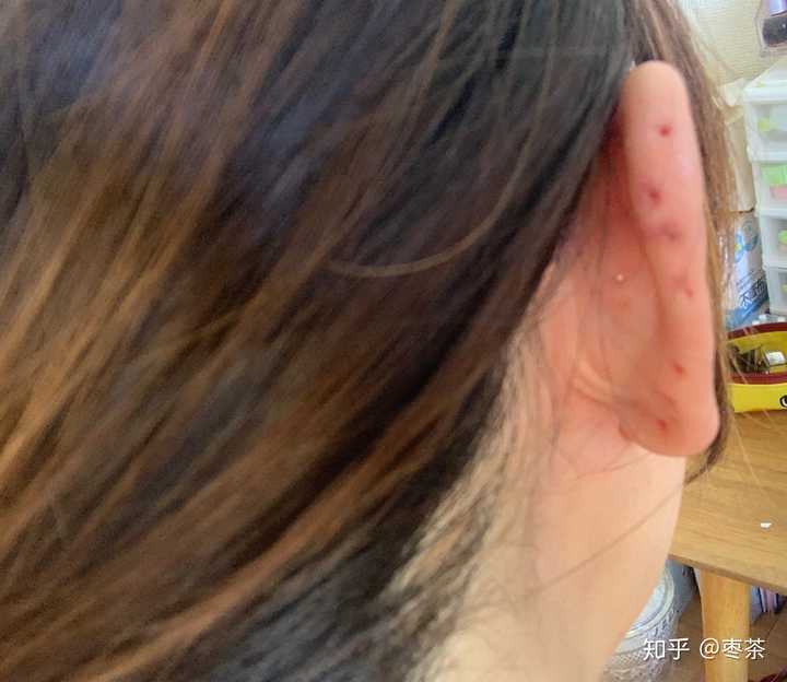 想问一下耳骨的耳钉摘下来什么样