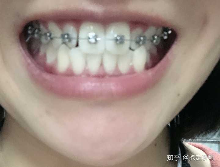 整牙成功的女生有多可怕?
