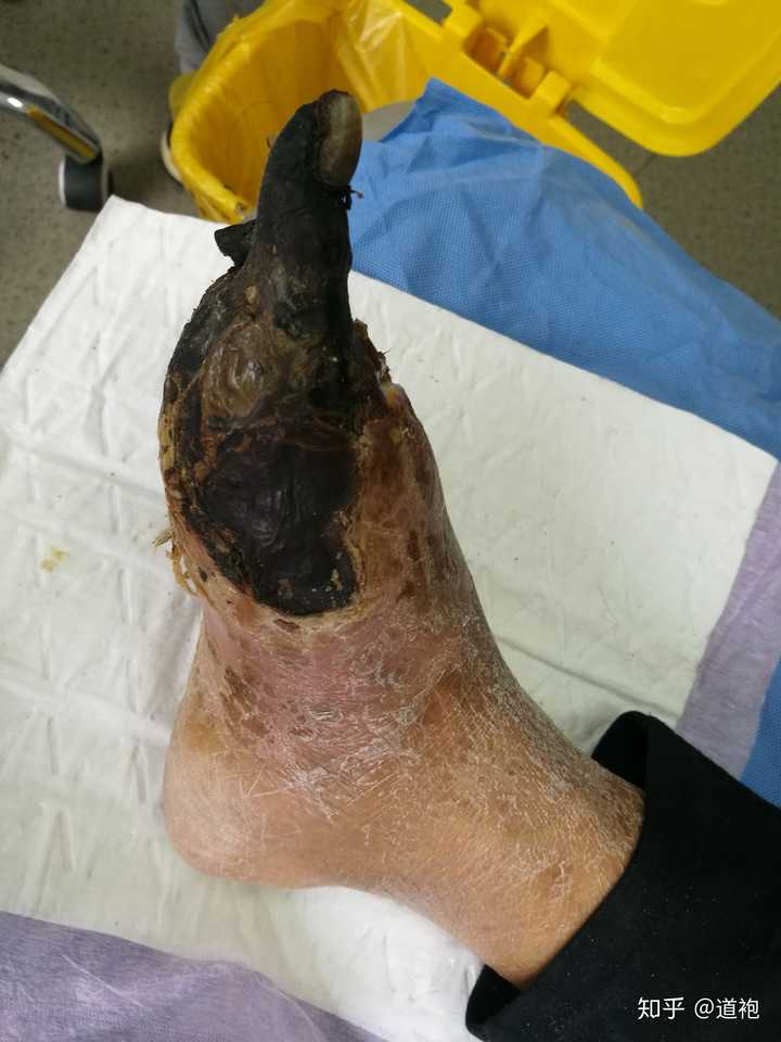 如何克服给糖尿病足病人换药时的恶心感?